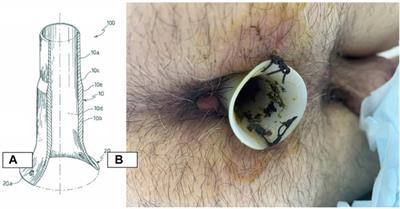 Left hemicolectomy and low anterior resection in colorectal cancer patients: Knight–griffen vs. transanal purse-string suture anastomosis with no-coil placement